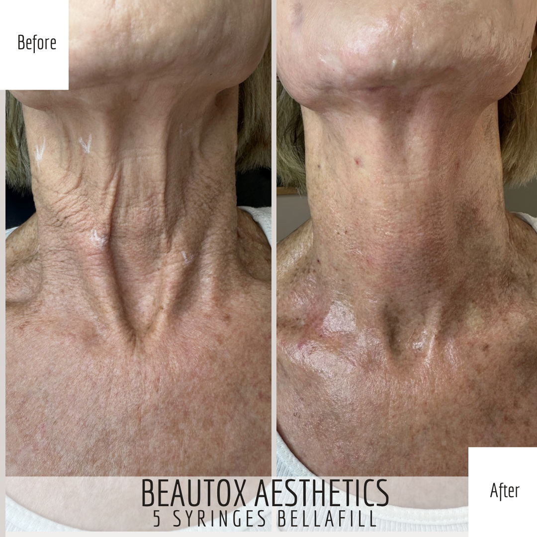 A before and after photo of a woman 's neck and shoulder.