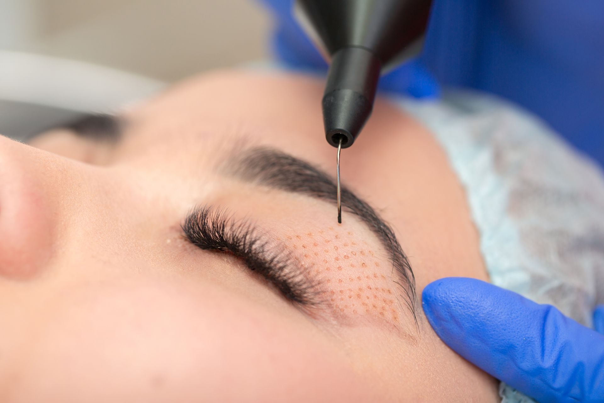 A woman is getting a plasma IQ treatment on her eyebrows.