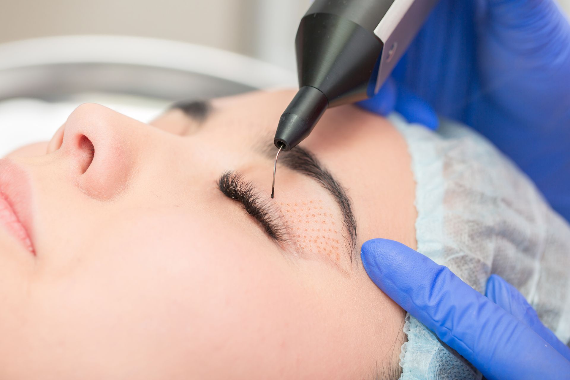 A woman is getting a plasma IQ treatment on her eyelids.