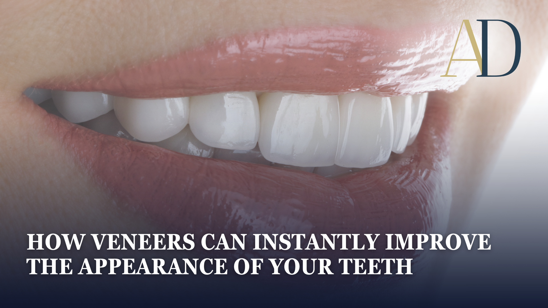 Close-up of a smiling mouth with bright white veneers and text about instantly improving teeth appearance