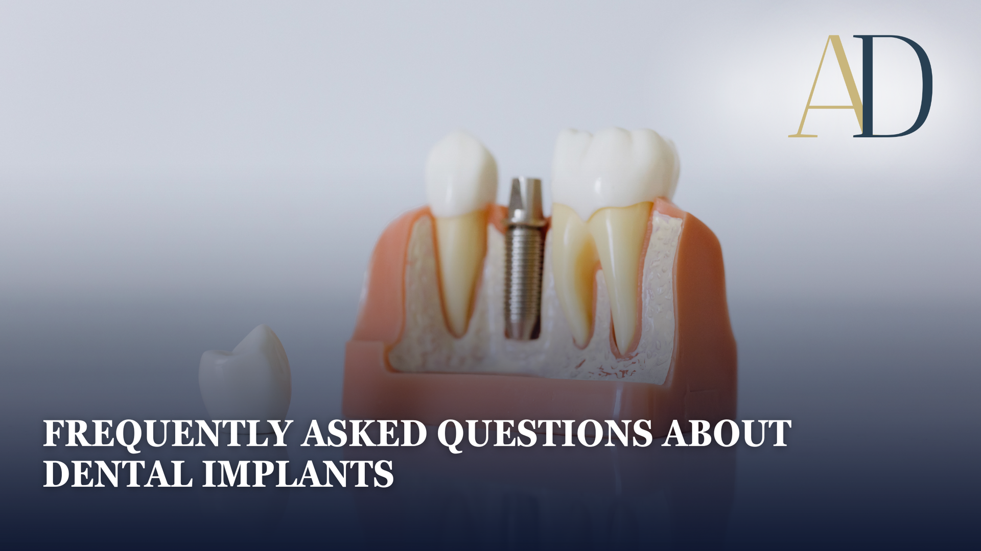 Dental implant FAQ banner with tooth and gum illustration on blue background