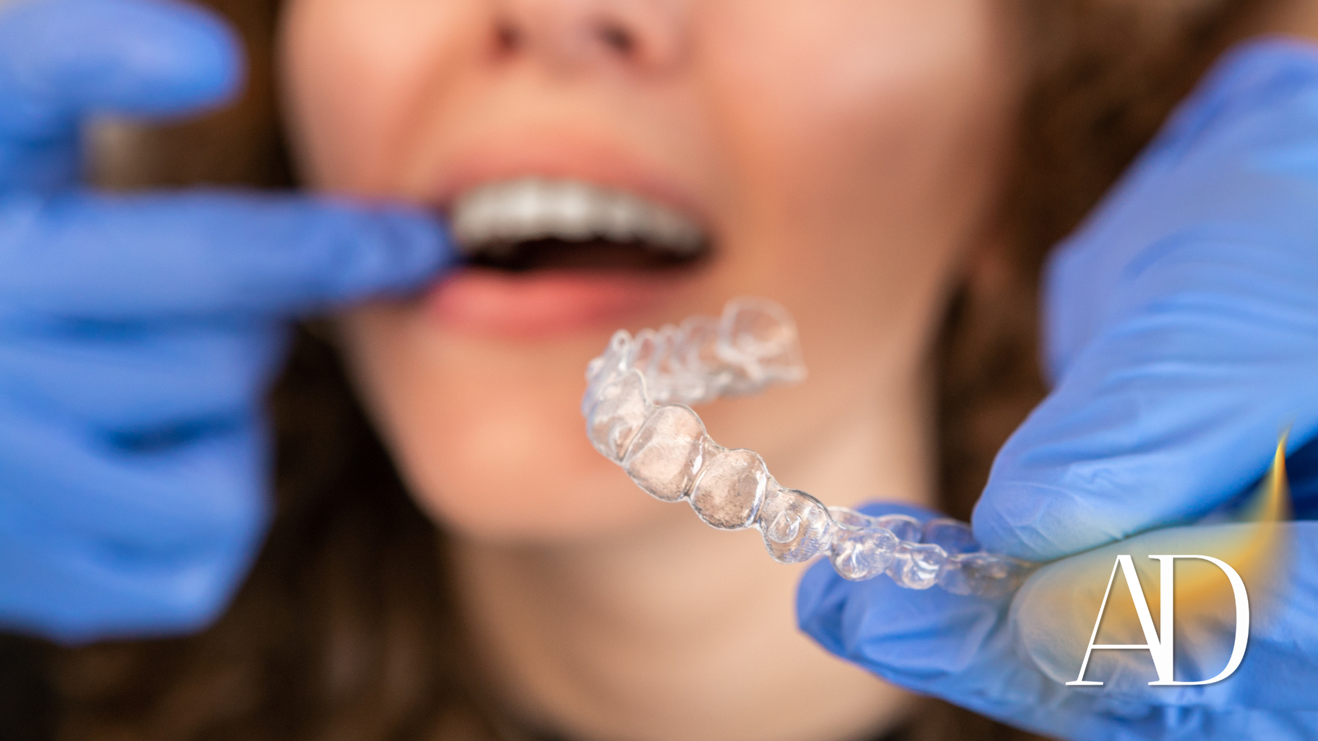 Gloved hands holding a clear dental aligner near a smiling mouth with braces or teeth visible