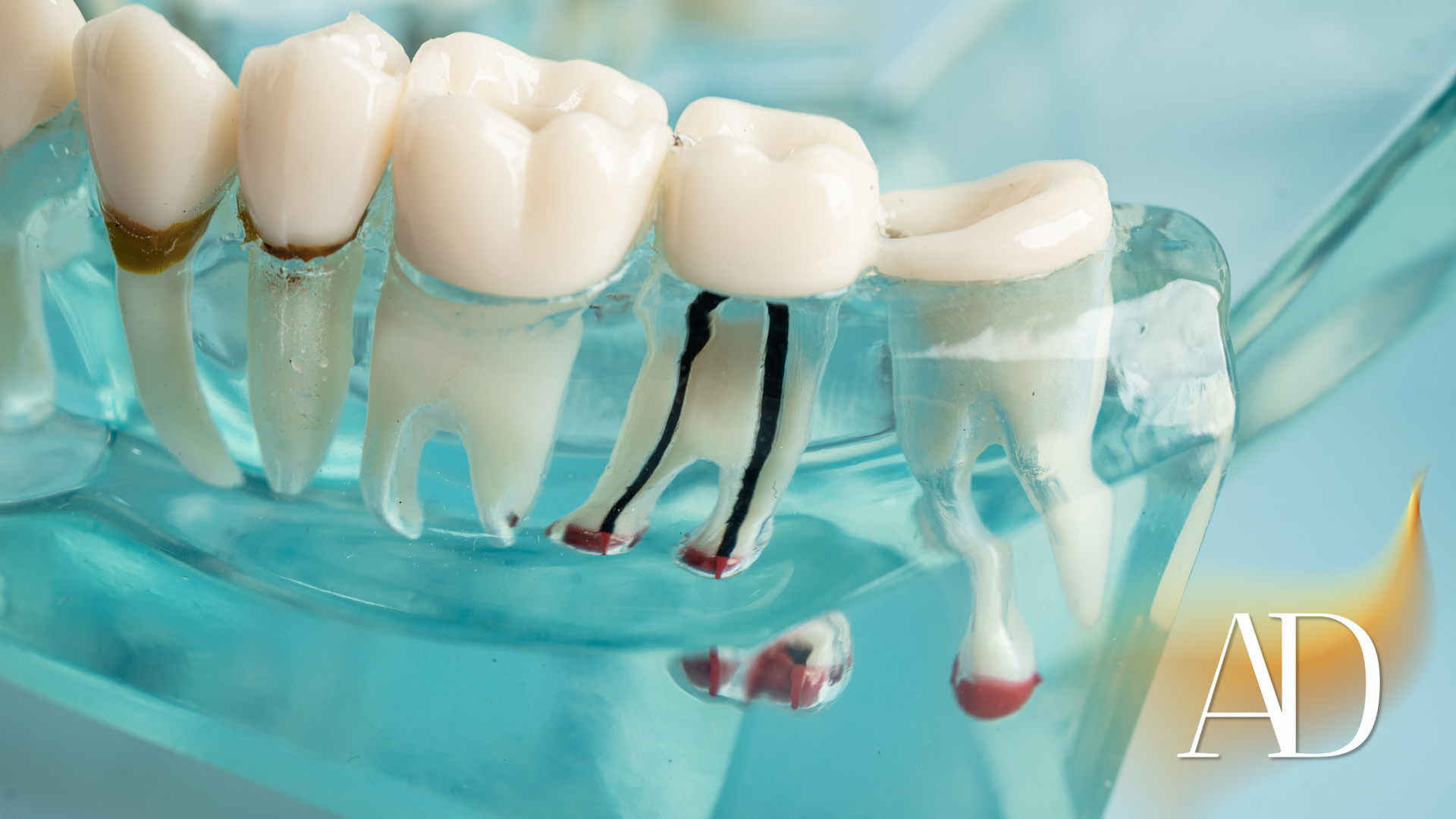 Dental implant model with white teeth, blue gum, and exposed metal posts on a light background