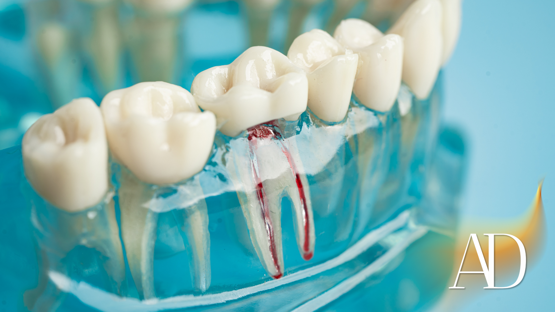 Close-up of a dental model showing a root canal procedure with exposed tooth roots and tools.