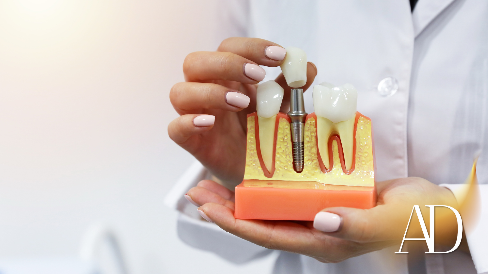 Dental implant model held by a gloved hand, showing tooth roots and crowns on a pink base.