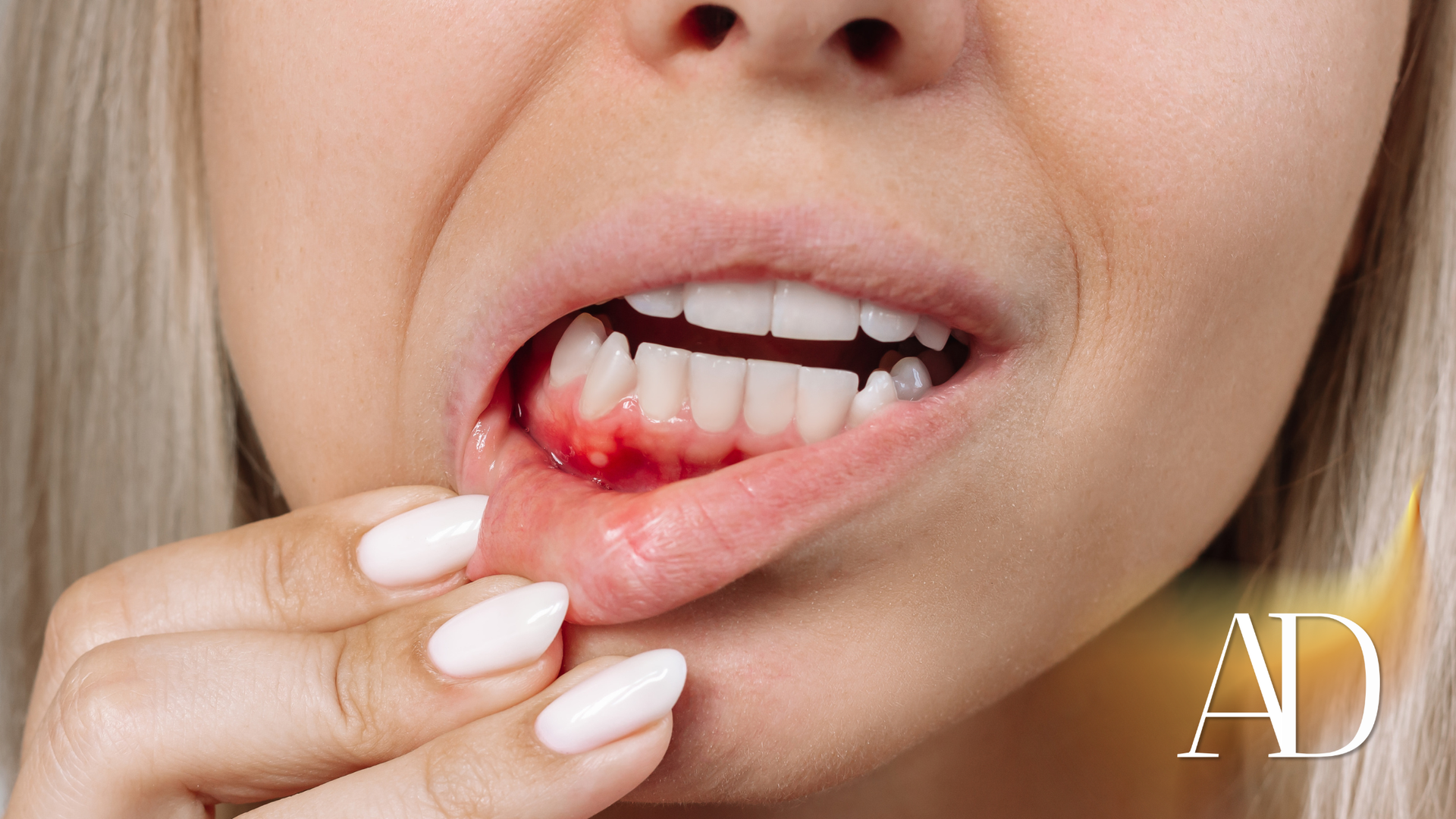 Close-up of a person pulling down a lip to reveal a bloody gum injury.