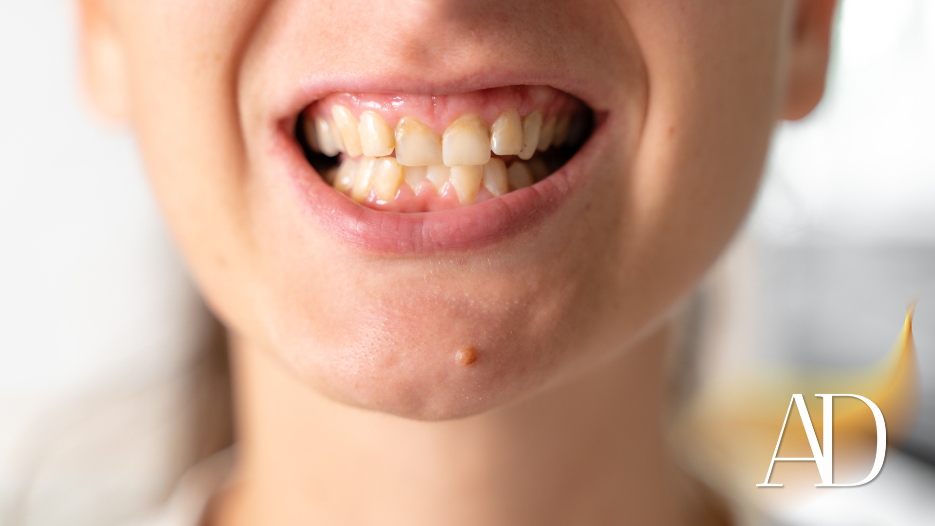 Close-up of a smiling mouth showing yellowed, stained teeth