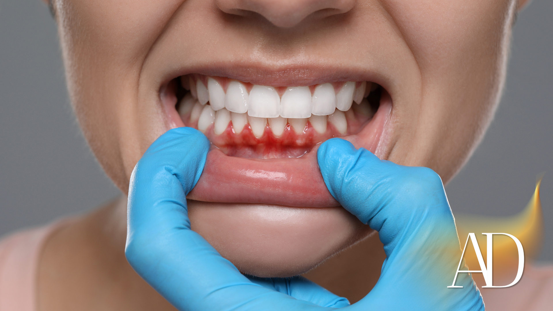 Gloved hands examining lower front teeth and gums during a dental checkup