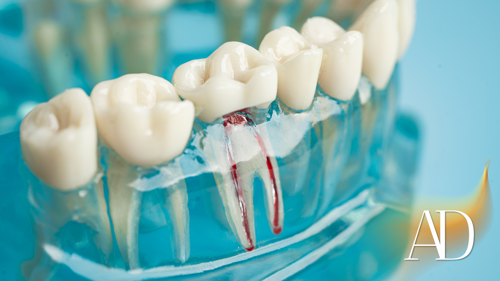 Dental model showing a crown procedure with a red-tinted tooth root on a clear base