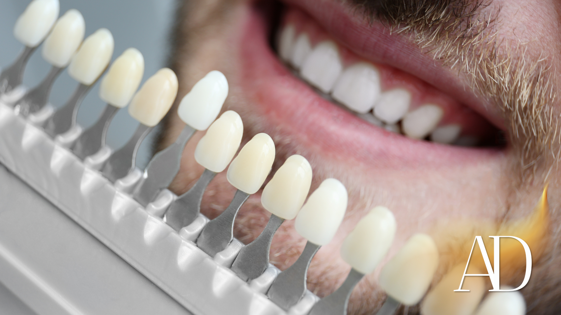 Close-up of smile with teeth shade guide, showing dental color comparison in a clinic setting