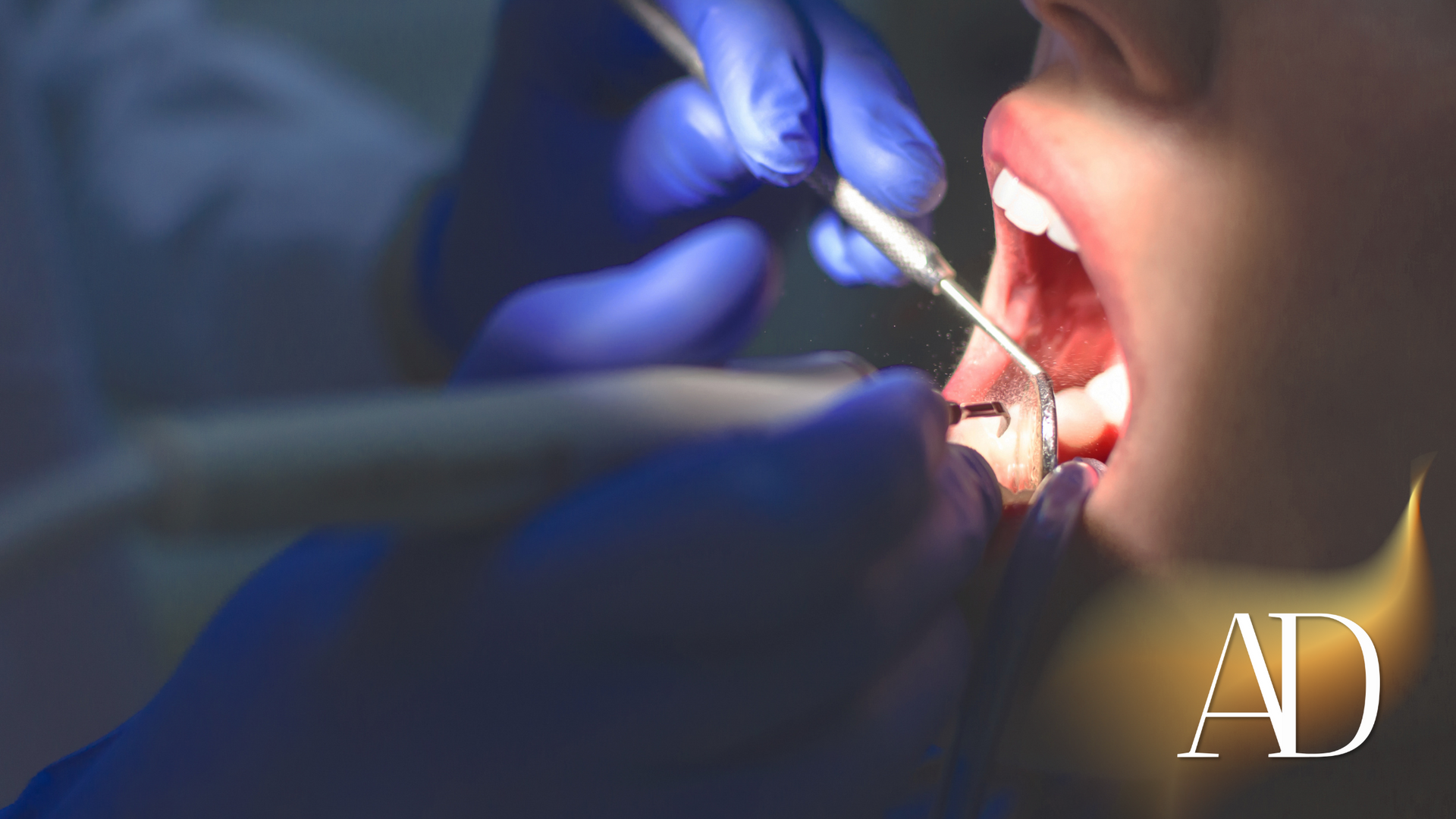 Dentist treating a patient’s open mouth with tools and blue gloves, close-up