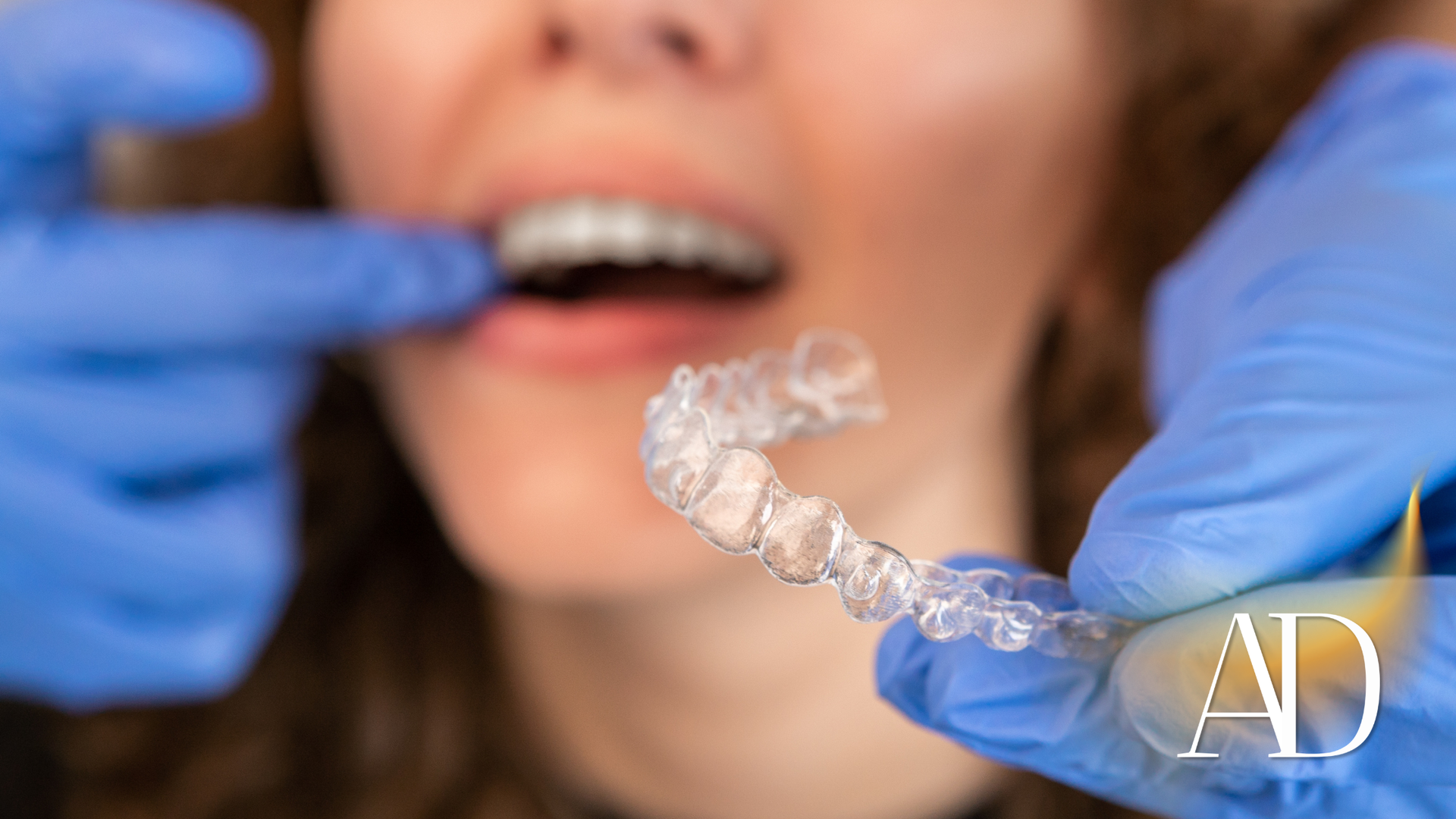 Dentist holding clear aligner near smiling mouth with blue gloves