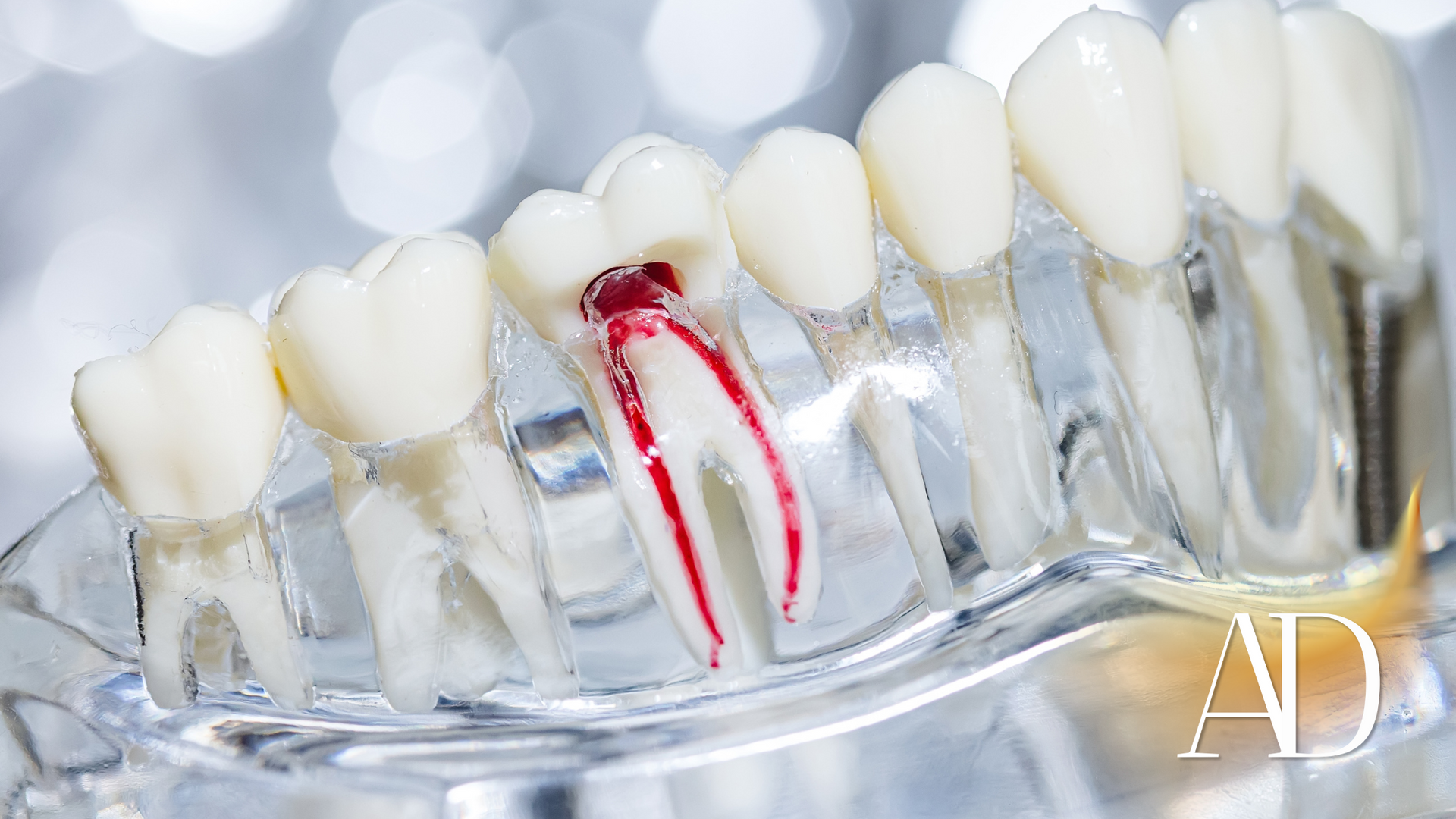 Teeth whitening tray over teeth, with one tooth marked in red and blue