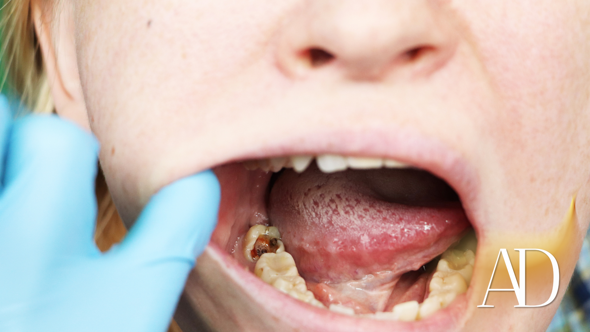 Close-up of an open mouth showing severe tooth decay, with a gloved hand examining it.