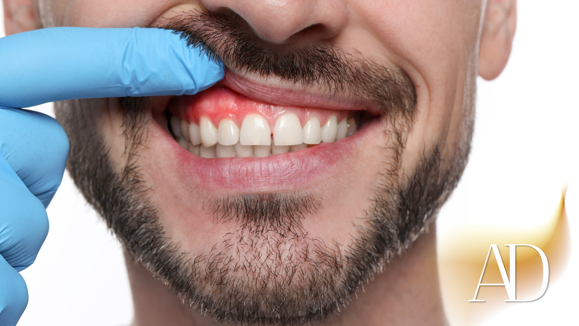 Gloved hand examining a man's upper teeth and gums close-up