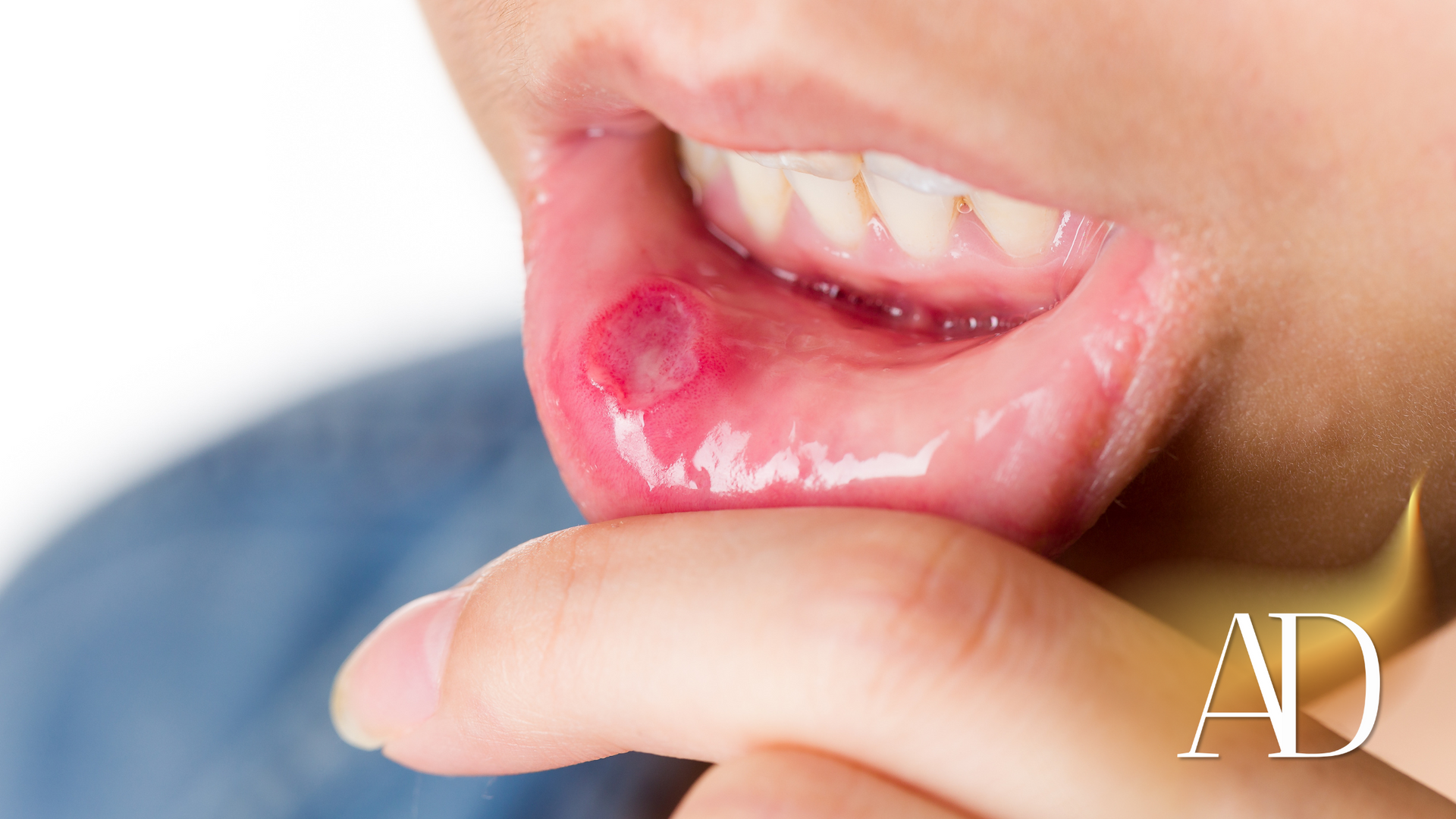 Close-up of a lower lip with a red mouth ulcer, pulled down by a finger