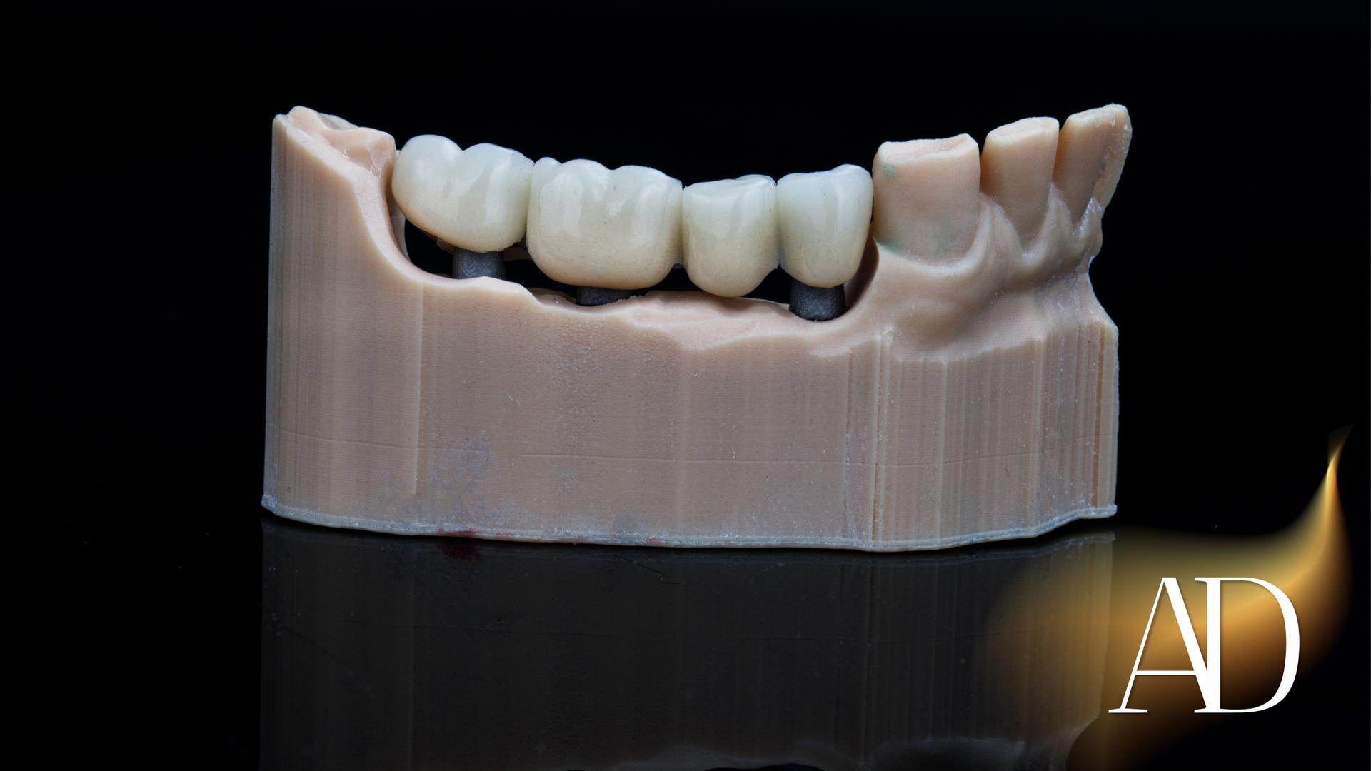 3D-printed dental model of upper teeth and gums on a black background