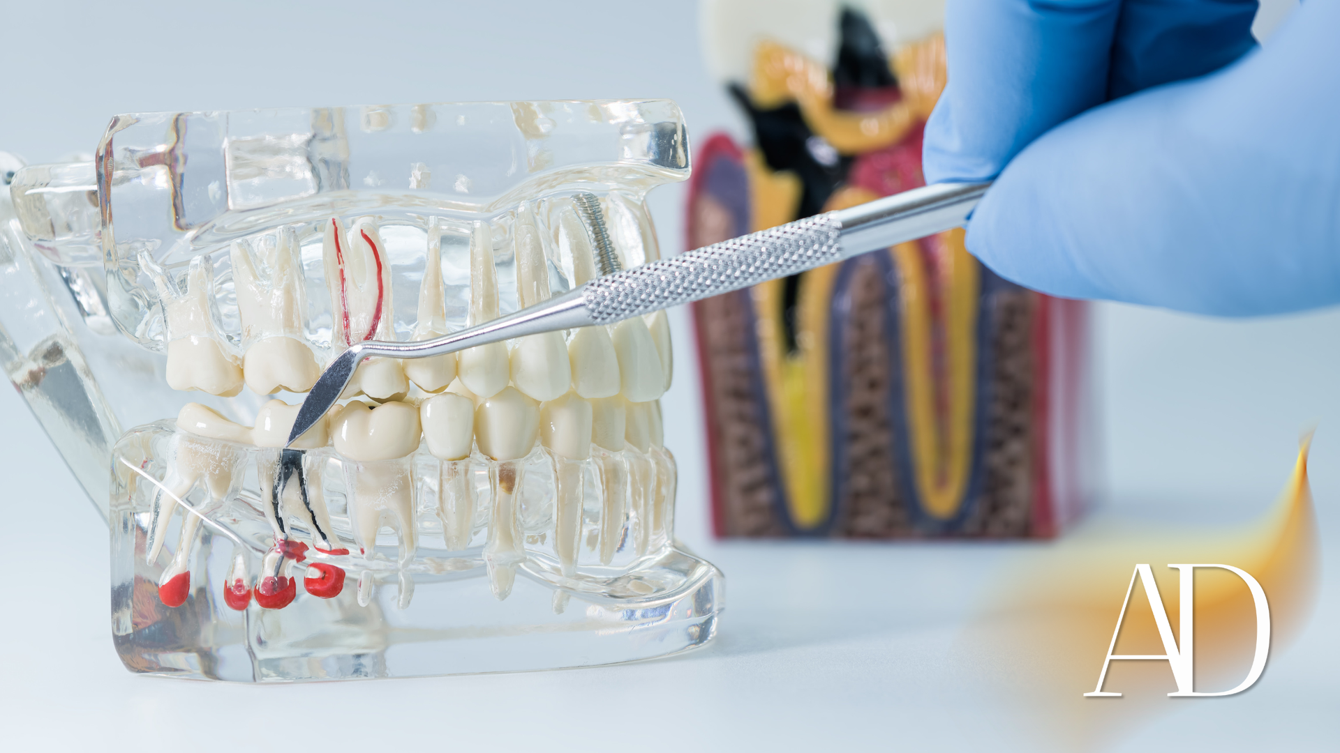 Gloved hand holding tweezers over dental model with red dental material in a clinic setting