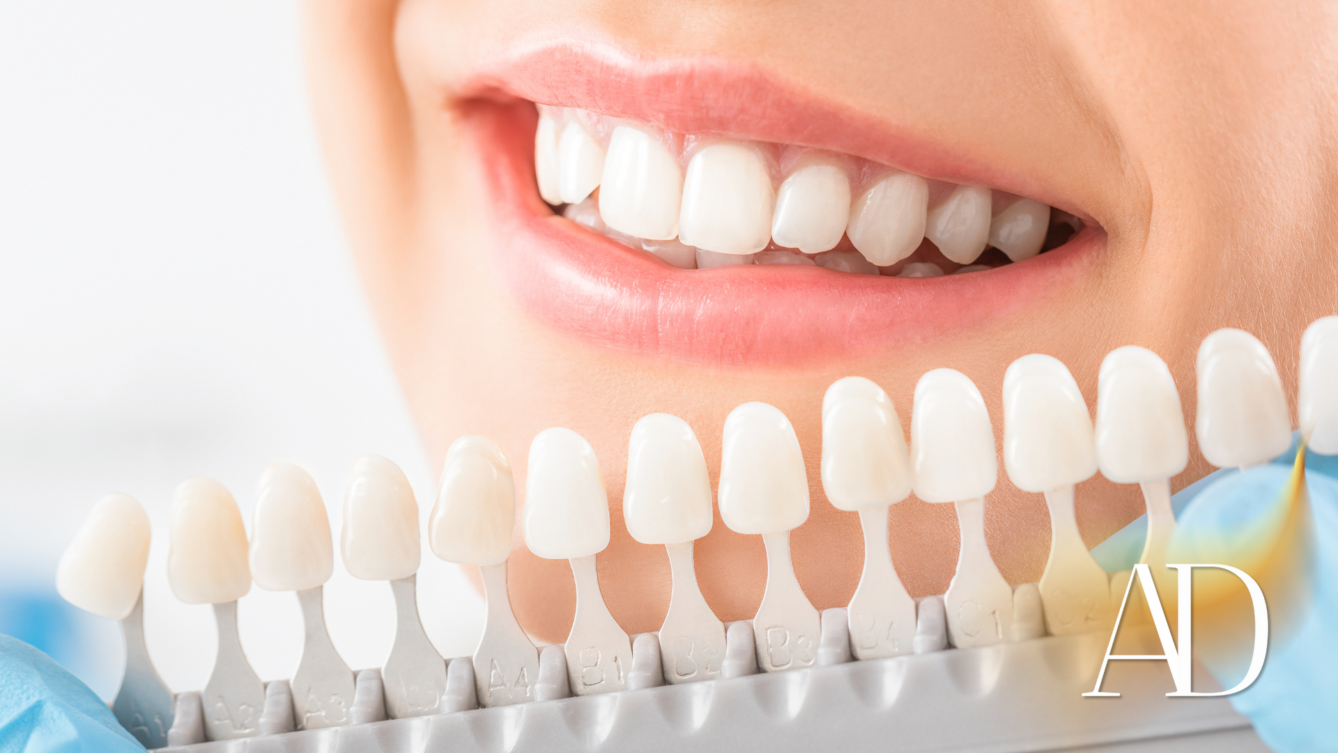 Smiling mouth beside a row of dental veneers on display, with “AD” watermark