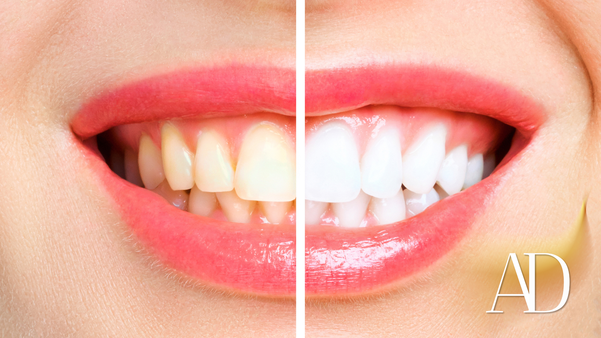 Close-up of a smiling mouth with pink lipstick, showing before-and-after teeth whitening