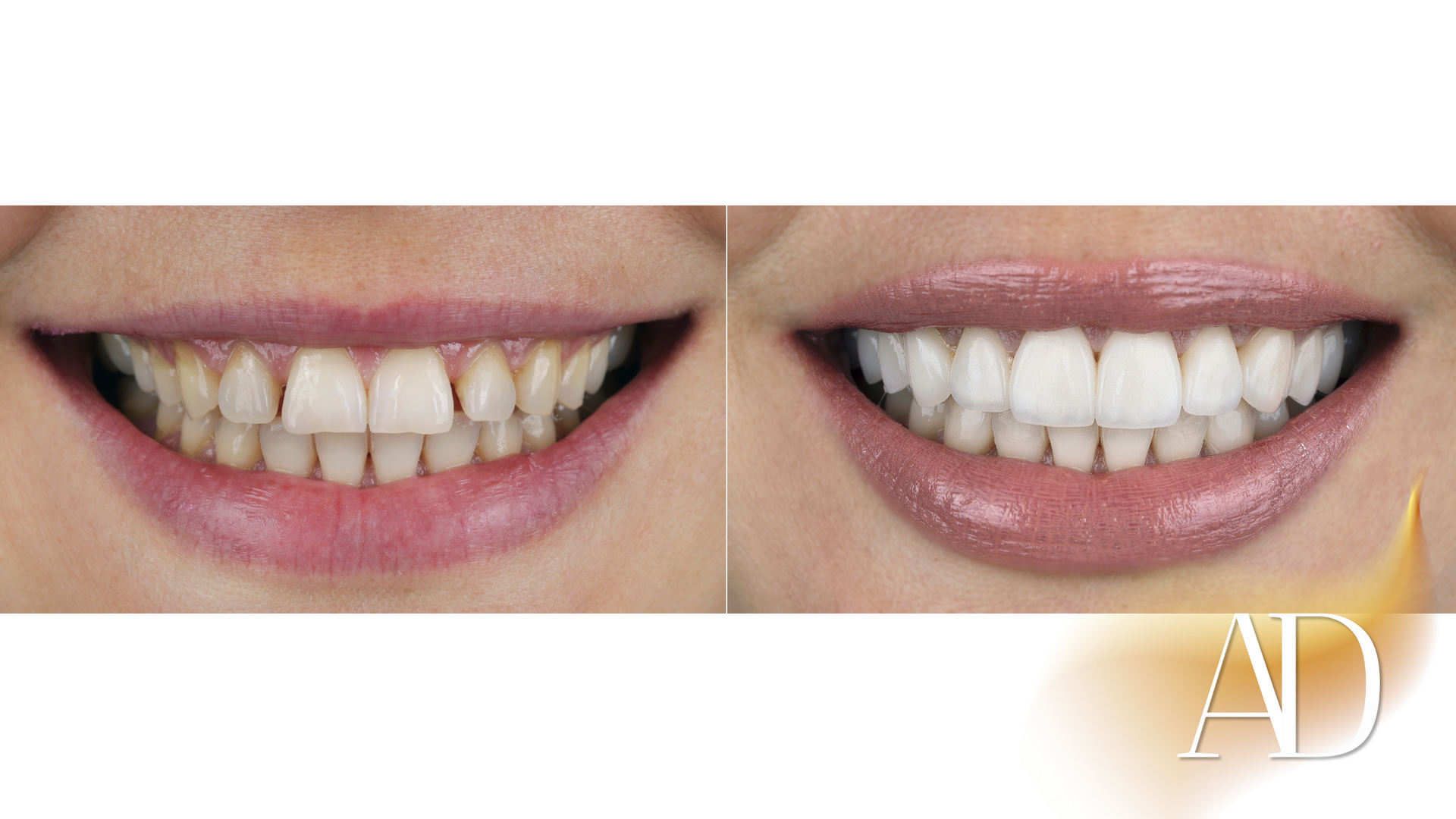 Split image of a smiling mouth before and after teeth whitening, showing brighter white teeth on the right