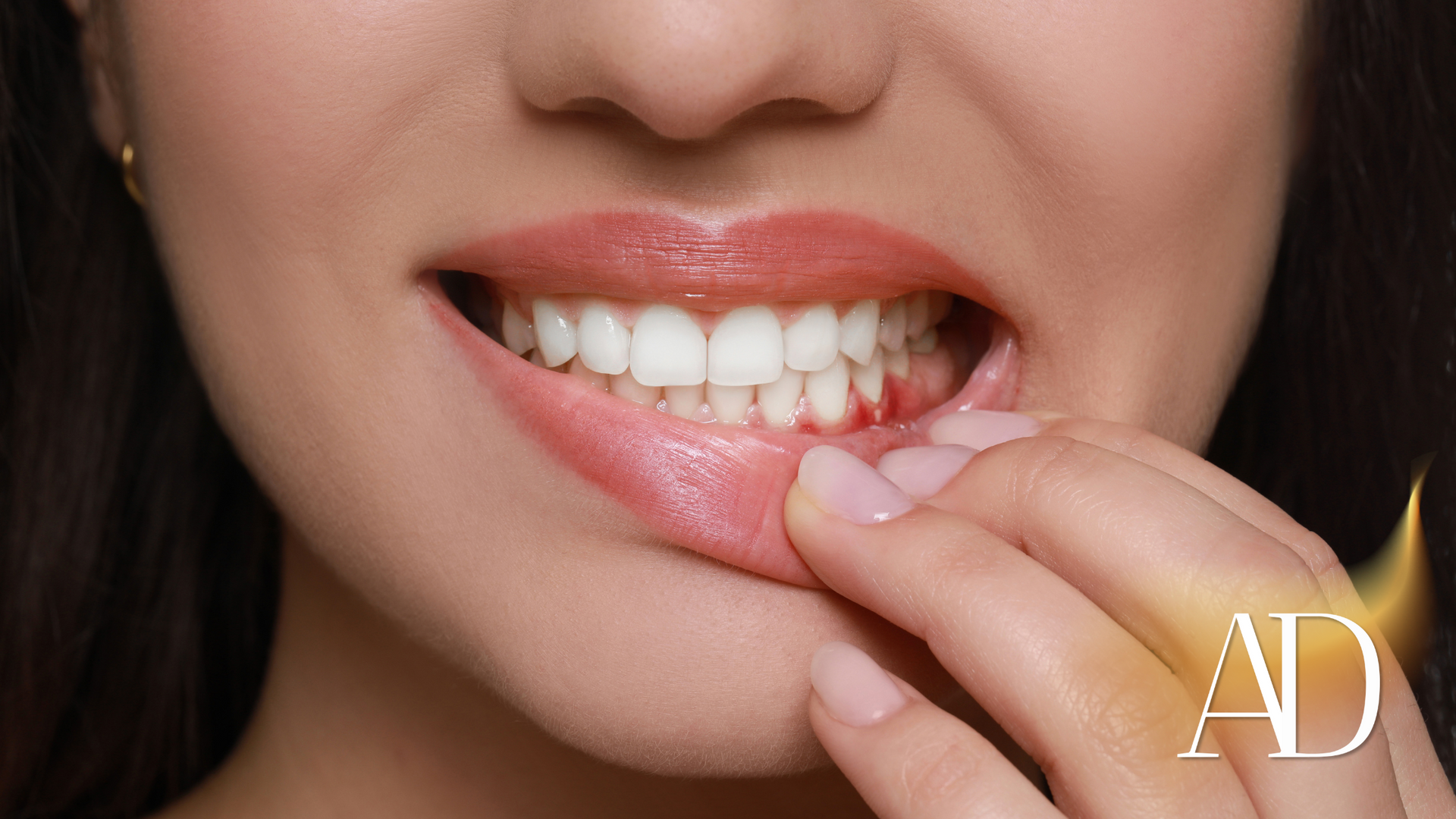 Close-up of smiling lips with a finger pulling back the lower lip to show teeth