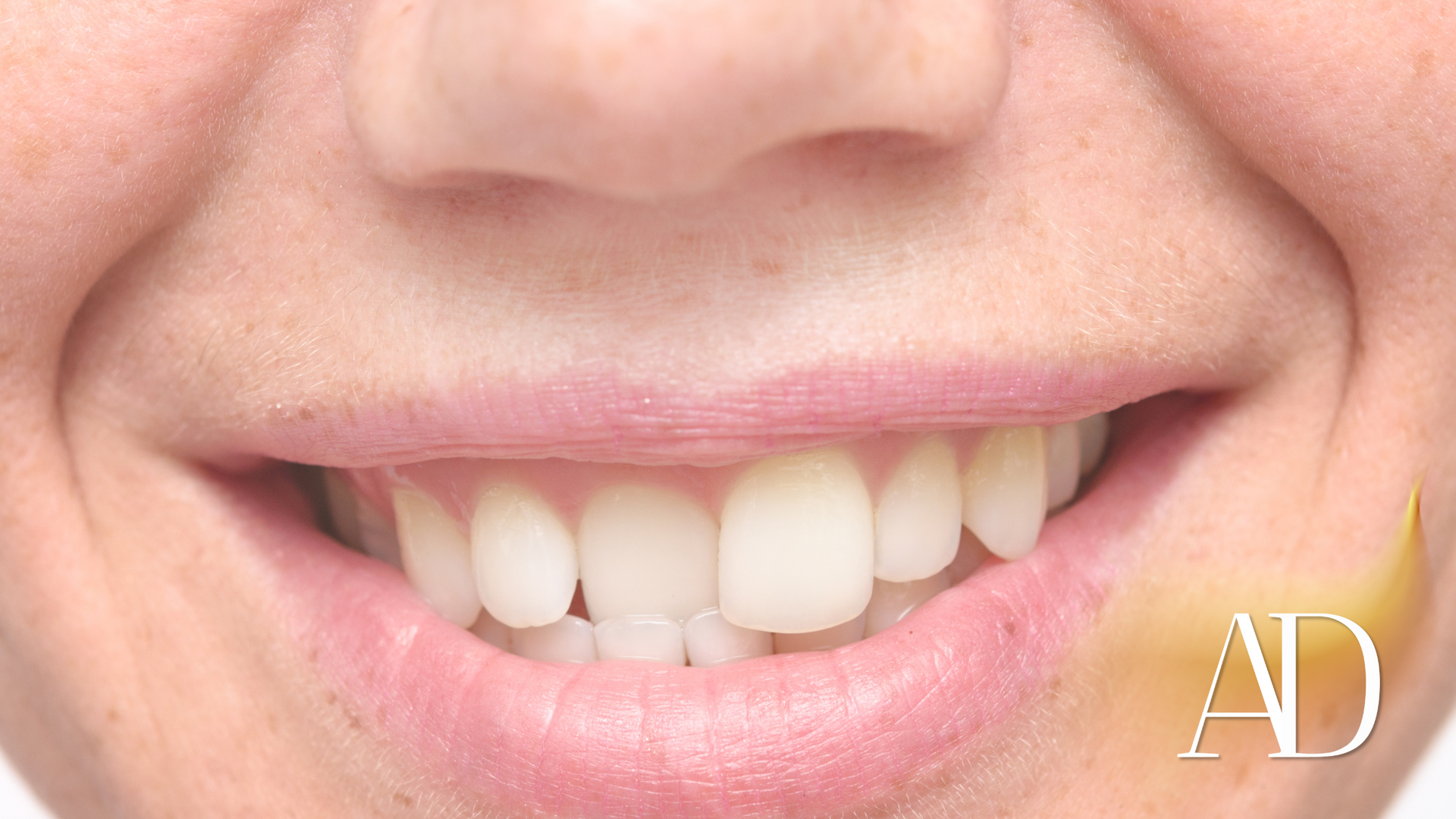 Close-up of a smiling mouth showing white teeth and pink lips, with a small AD watermark in the corner.