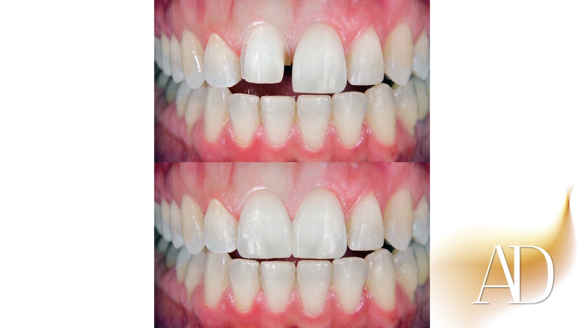 Before-and-after close-up of teeth with a gap between upper front teeth, shown on pink gums.