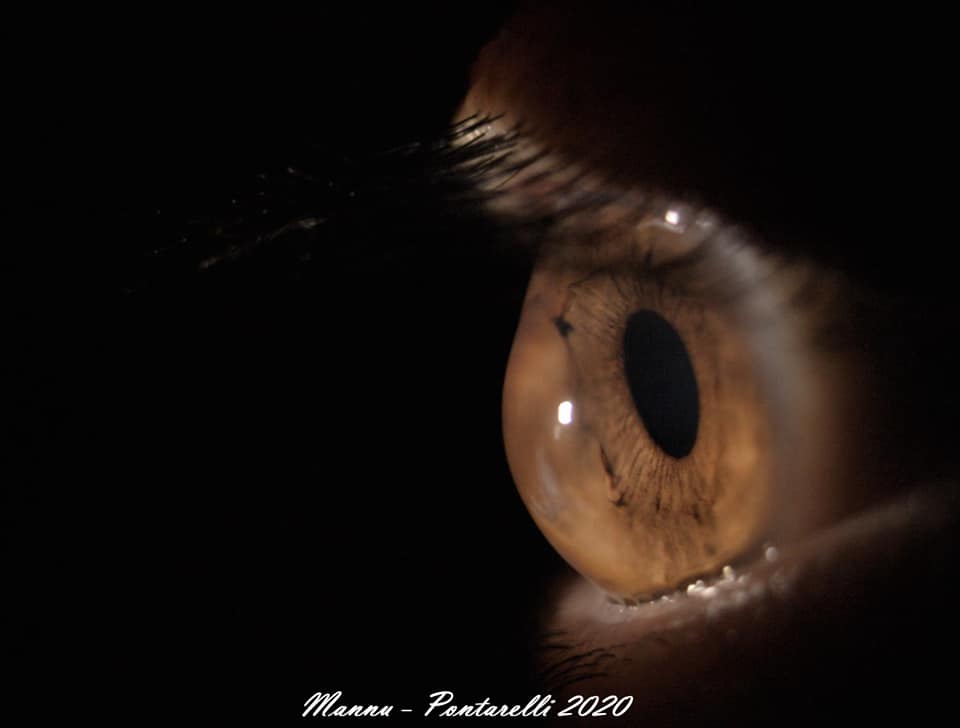 cornea con cheratocono foto