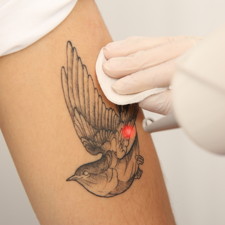 Laser tattoo removal on a forearm tattoo