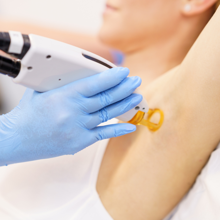 Laser hair removal on the underarm