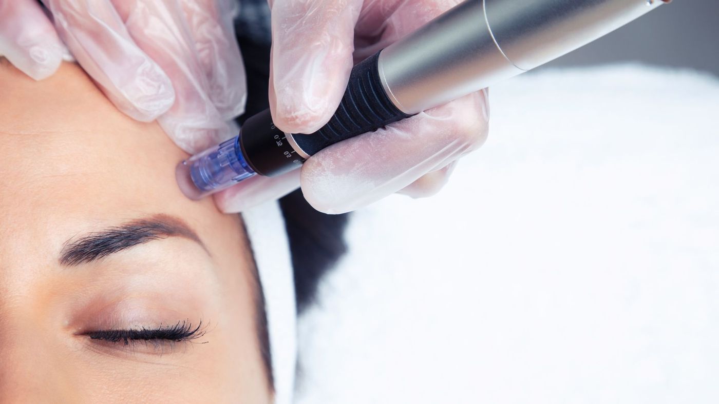 A microneedling pen moving across the forehead