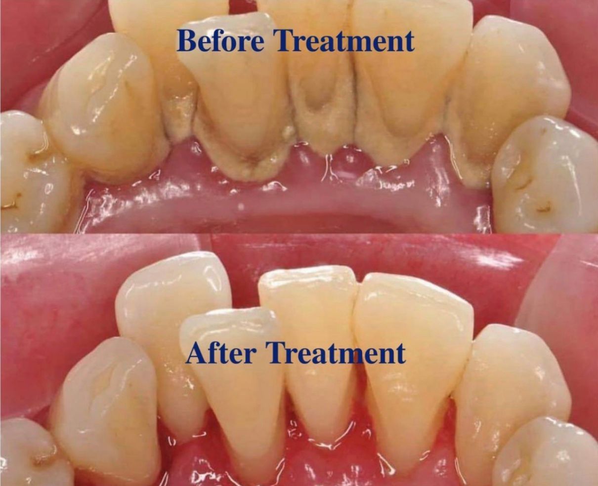 Clean teeth