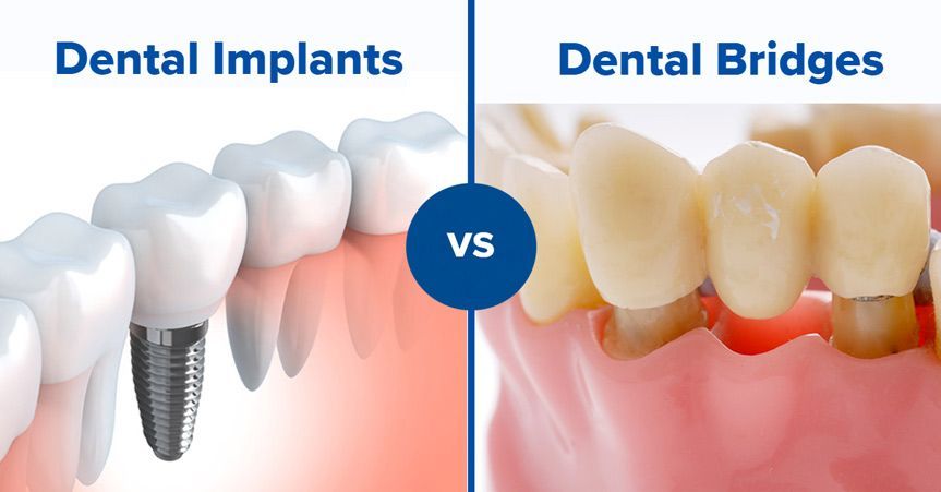 Dental Bridges vs Dental Implants