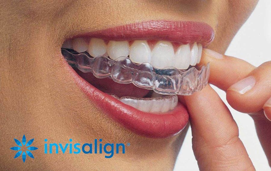 Invisalign
