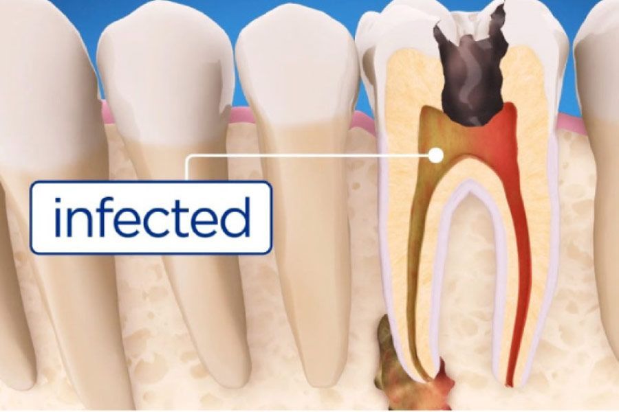 Root canal