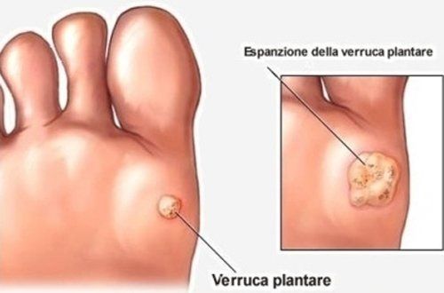 Verruche del piede