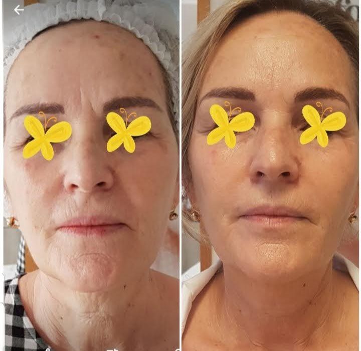 Una foto prima e dopo del viso di una donna con farfalle gialle sugli occhi