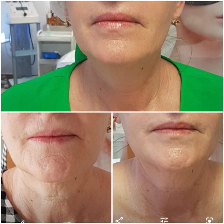 Una foto del prima e del dopo del viso di una donna