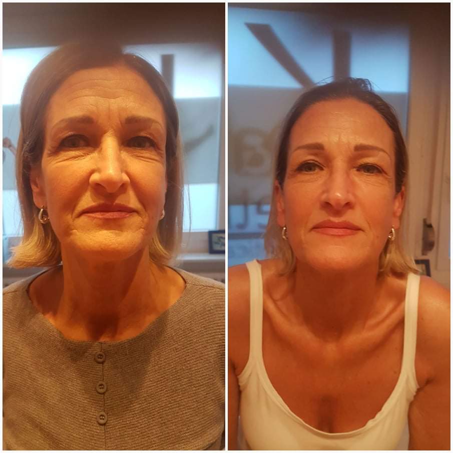 Una foto del viso di una donna prima e dopo.