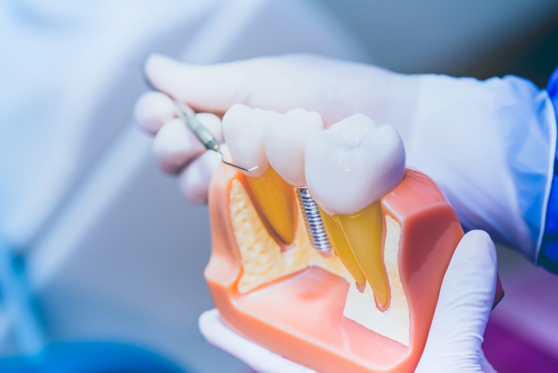 A Dentist Is Holding a Model of A Tooth with A Screw in It — Cane to Coast Dentures in Proserpine, QLD