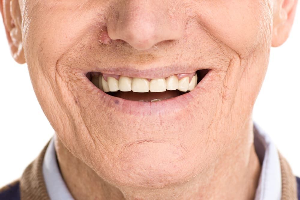 A Close-up Of an Elderly Man's Smile with White Teeth — Cane to Coast Dentures in Sarina, QLD