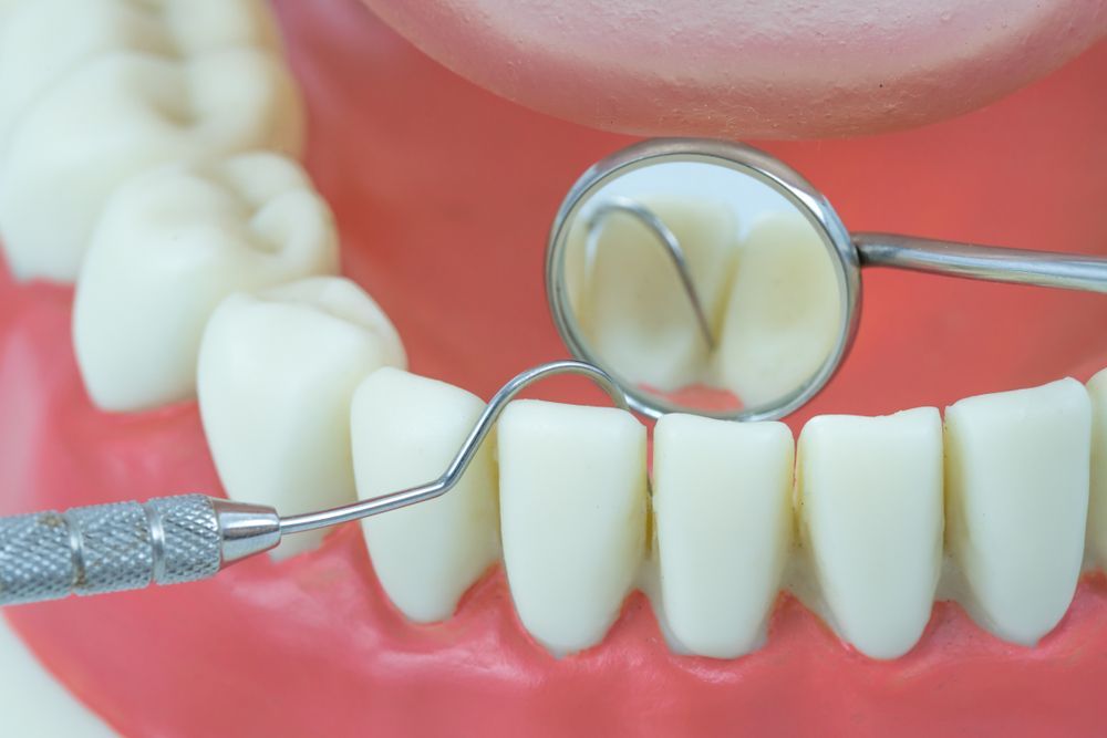 A Dentist is Examining a Model of a Person's Teeth With a Mirror — Graham Johnson Dental Surgery In Beresfield, NSW
