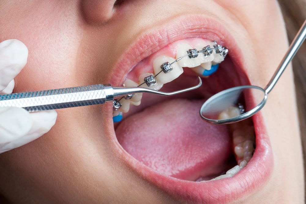 A Woman With Braces is Getting Her Teeth Examined by a Dentist— Graham Johnson Dental Surgery In Beresfield, NSW