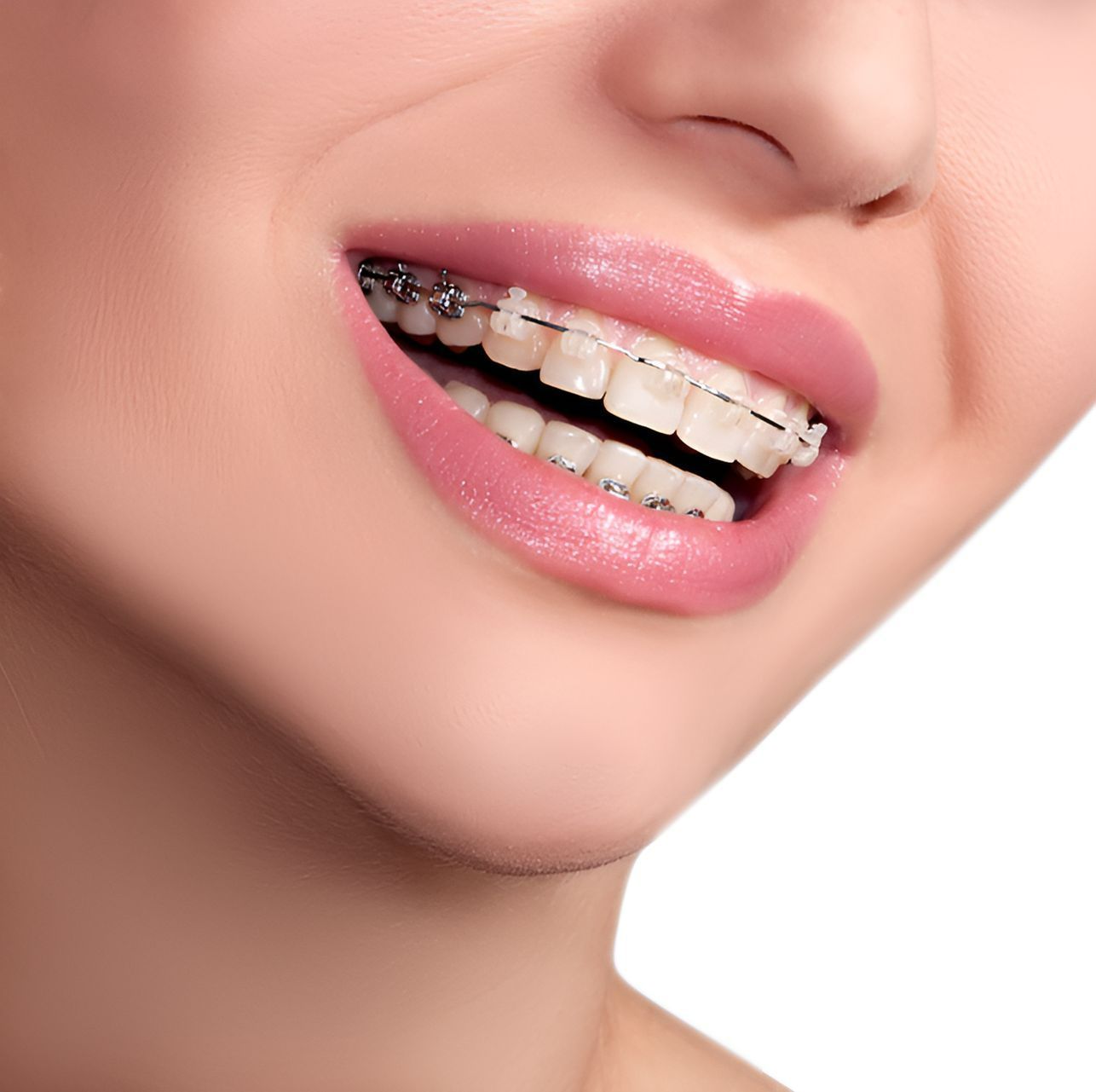 A Close Up of a Woman 's Mouth With Braces on Her Teeth — Graham Johnson Dental Surgery In Beresfield, NSW