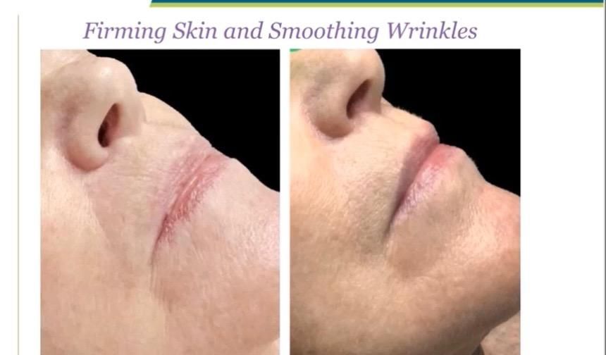 Side-by-side view of a nose and mouth before and after a cosmetic procedure to smooth wrinkles.