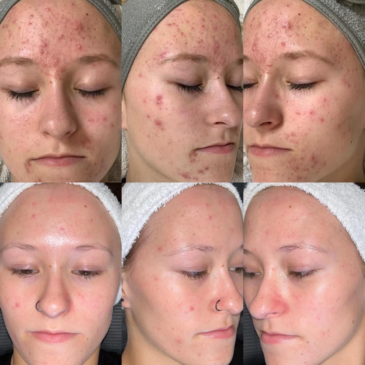 Comparison of acne before and after treatment on a woman's face. Top row: red, inflamed skin.