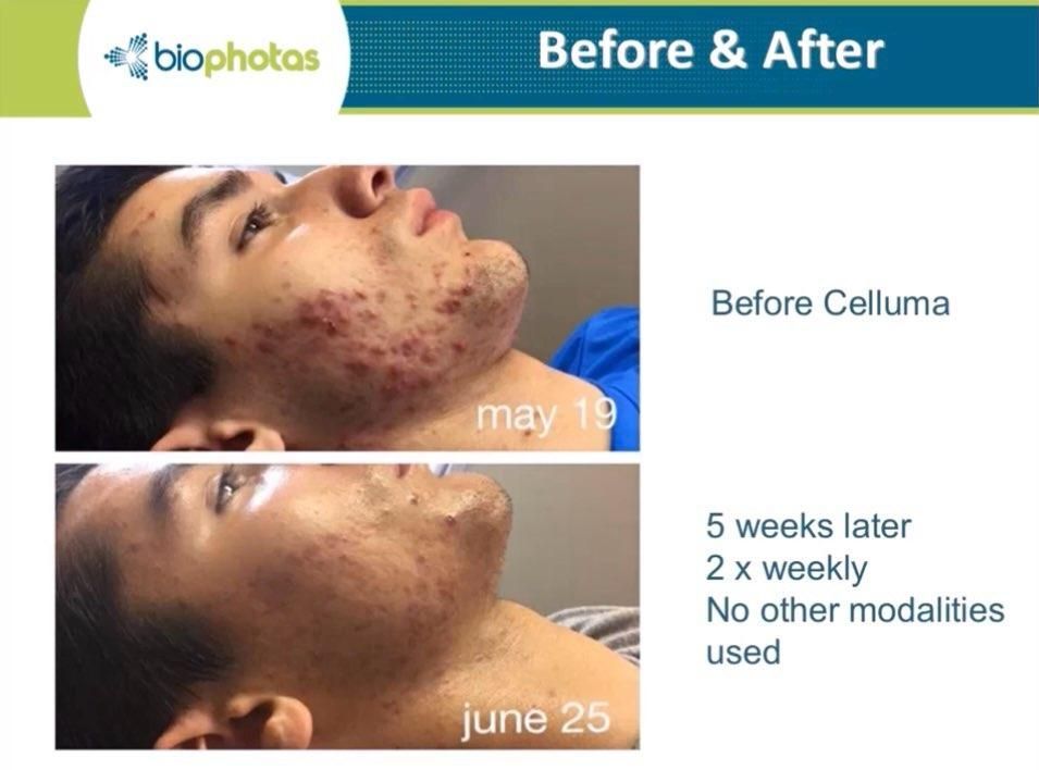 Before and after comparison of acne treatment. May 19: acne on face. June 25: reduced acne after Celluma treatment.