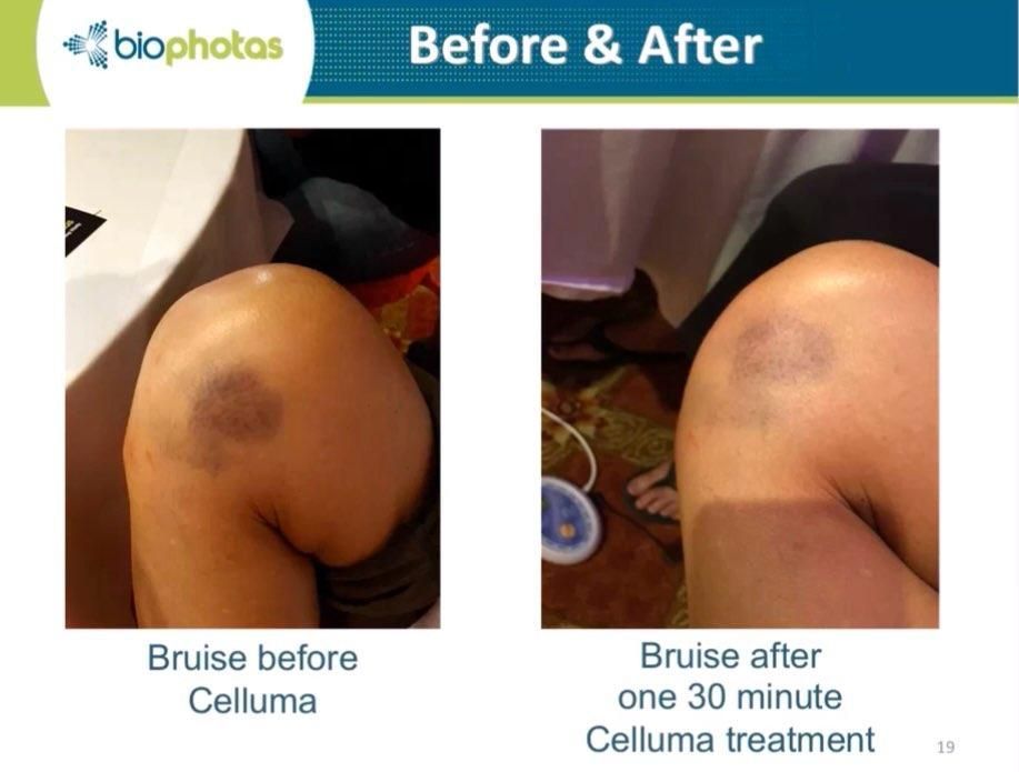Before-and-after of knee bruise. Left: purple bruise. Right: less visible bruise after 30-minute Celluma treatment.