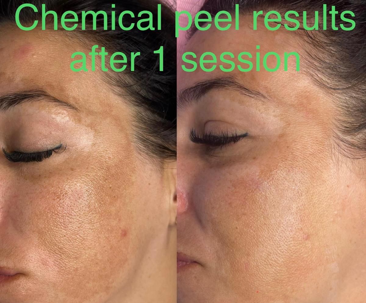 Comparison of a woman's face before and after a chemical peel. Skin discoloration and blemishes visibly reduced.